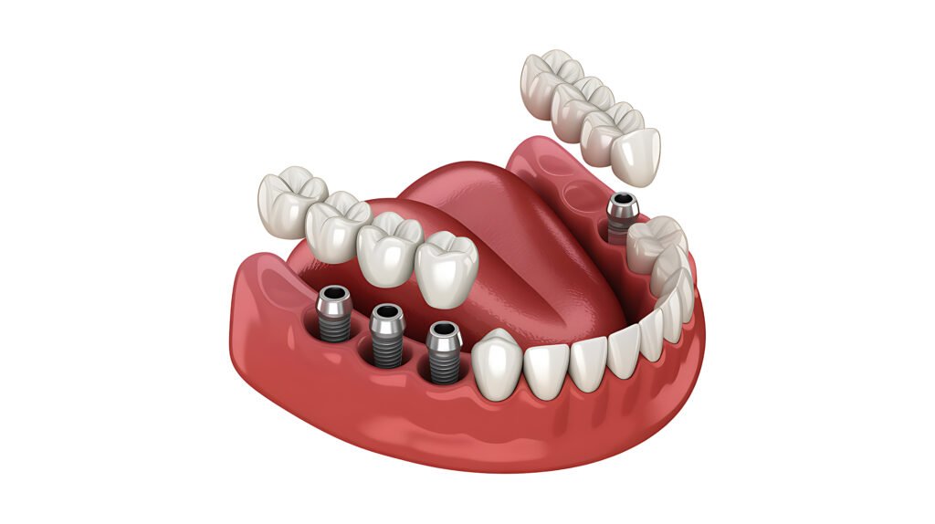 All-on-4 diş implantı tedavisi — alt çene için 3 boyutlu implant görseli