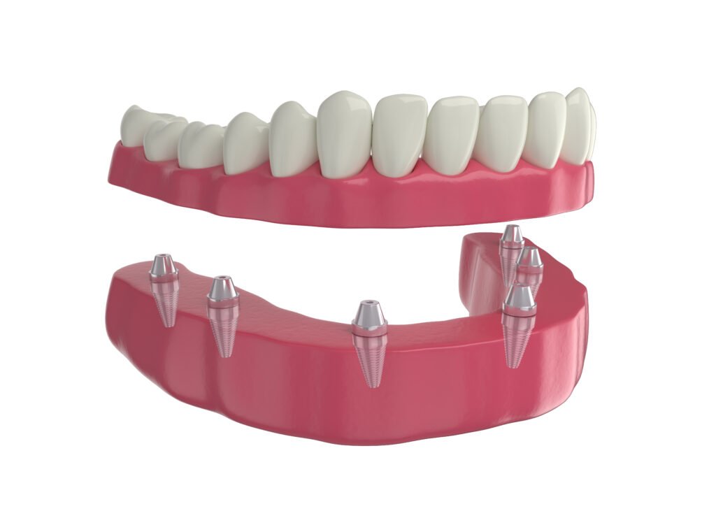 Alt çenede altı implant üzerine sabit protez — All-on-6 üç boyutlu görsel