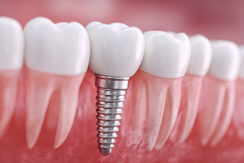 Çene kemiğine yerleşmiş diş implantı ve komşu dişler — çekim sonrası implant