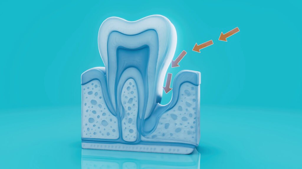 Diş eti hastalığının (periodontitis) üç boyutlu görseli — gingivitis periodontitis