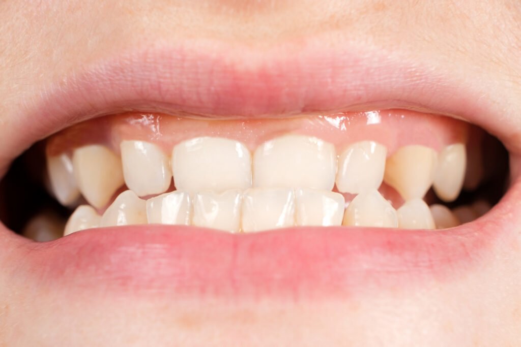 Gummy smile (diş eti gülüşü) — belirgin diş eti görünümü yakın çekim