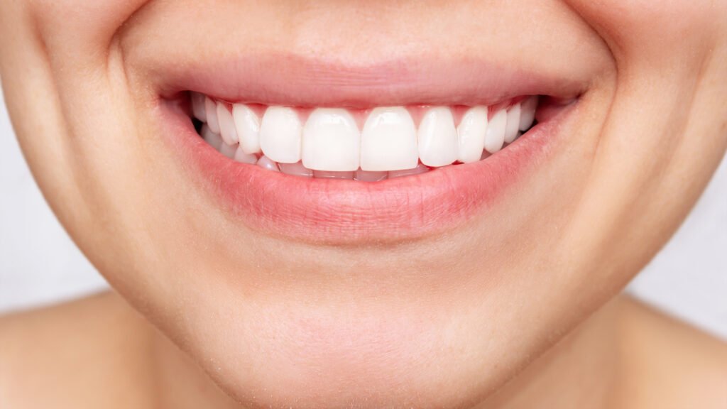 Lamina sonrası beyaz ve düzgün dişlerle gülümseyen kadın — Hollywood smile