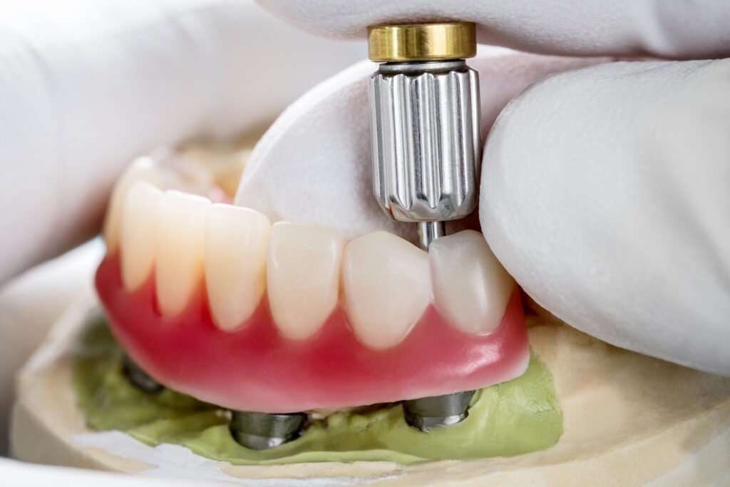 İmplant destekli protez (overdenture) yakın çekim — protez mi implant mı