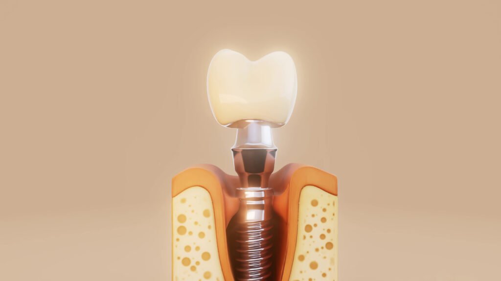 Üst çenede diş implantının çene kemiği içindeki 3 boyutlu görseli — sinüs lifting